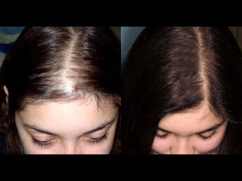 How to Control Hair loss with Natural Remedies | Hair fall Treatment | Hair Care | Hair Care Tips